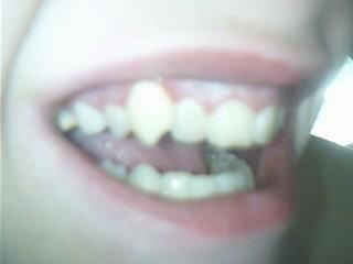 Echte Vampirzahne Erstellen Lassen Zahnarzt