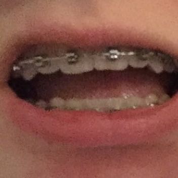 Ist Es Normal Dass Die Eckzahne Sehr Spitz Sind Zahnarzt Eckzahn