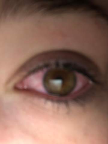 Ein Auge Rot Nach Dem Kiffen Drogen Ein Auge Rot Nach Dem Kiffen Drogen