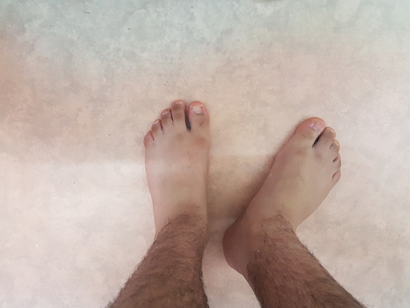 Ein Fuss Zeigt Nach Aussen Beim Stehen Und Laufen Bis Heute Nicht Gemerkt Was Ist Das Habe Keine Schmerzen Bild Ist Dabei Fusse Fehlstellung