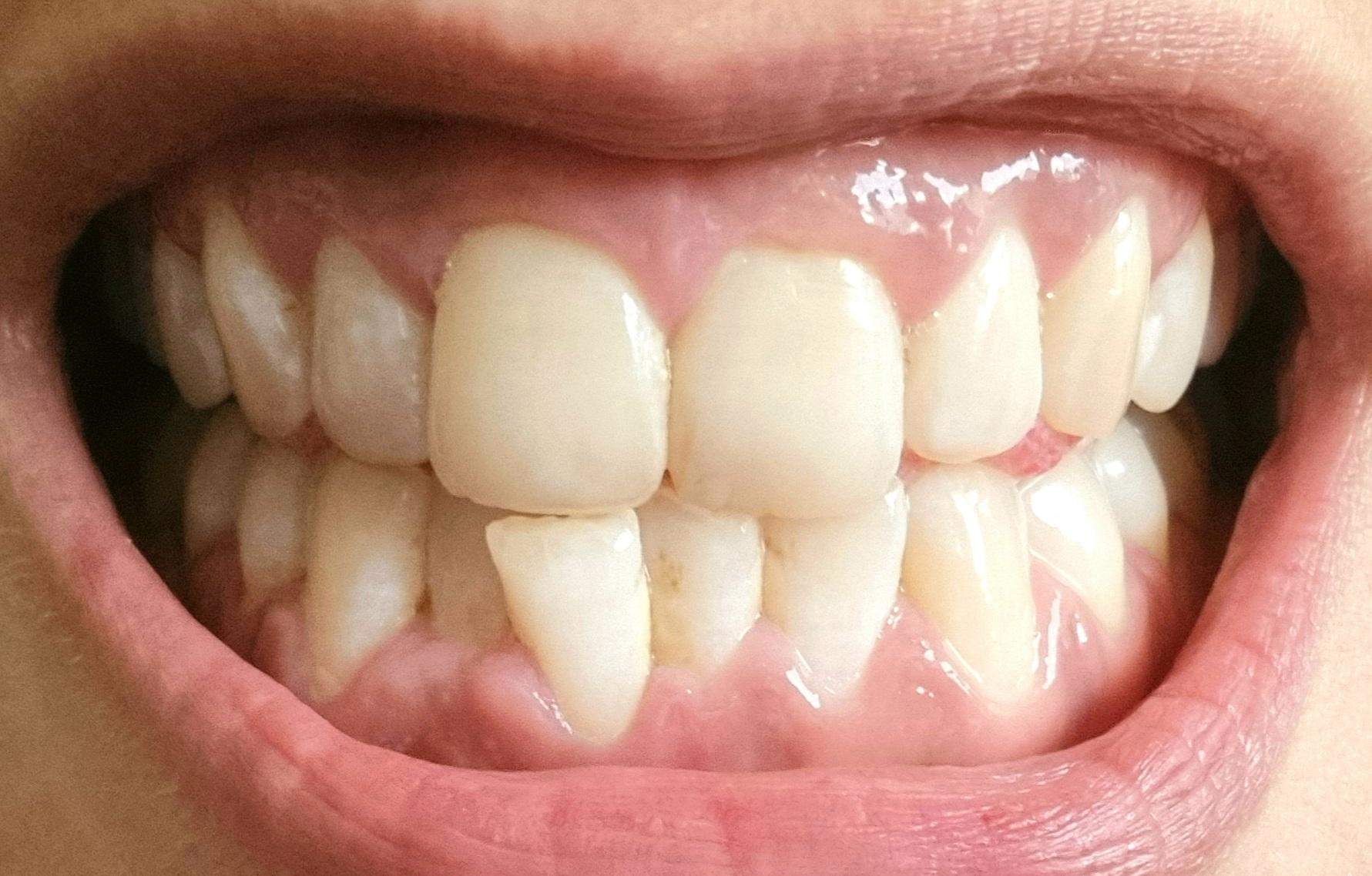 Ein gesunden Schneidezahn ziehen aus Ästhetischen Gründen? (Meinung ...