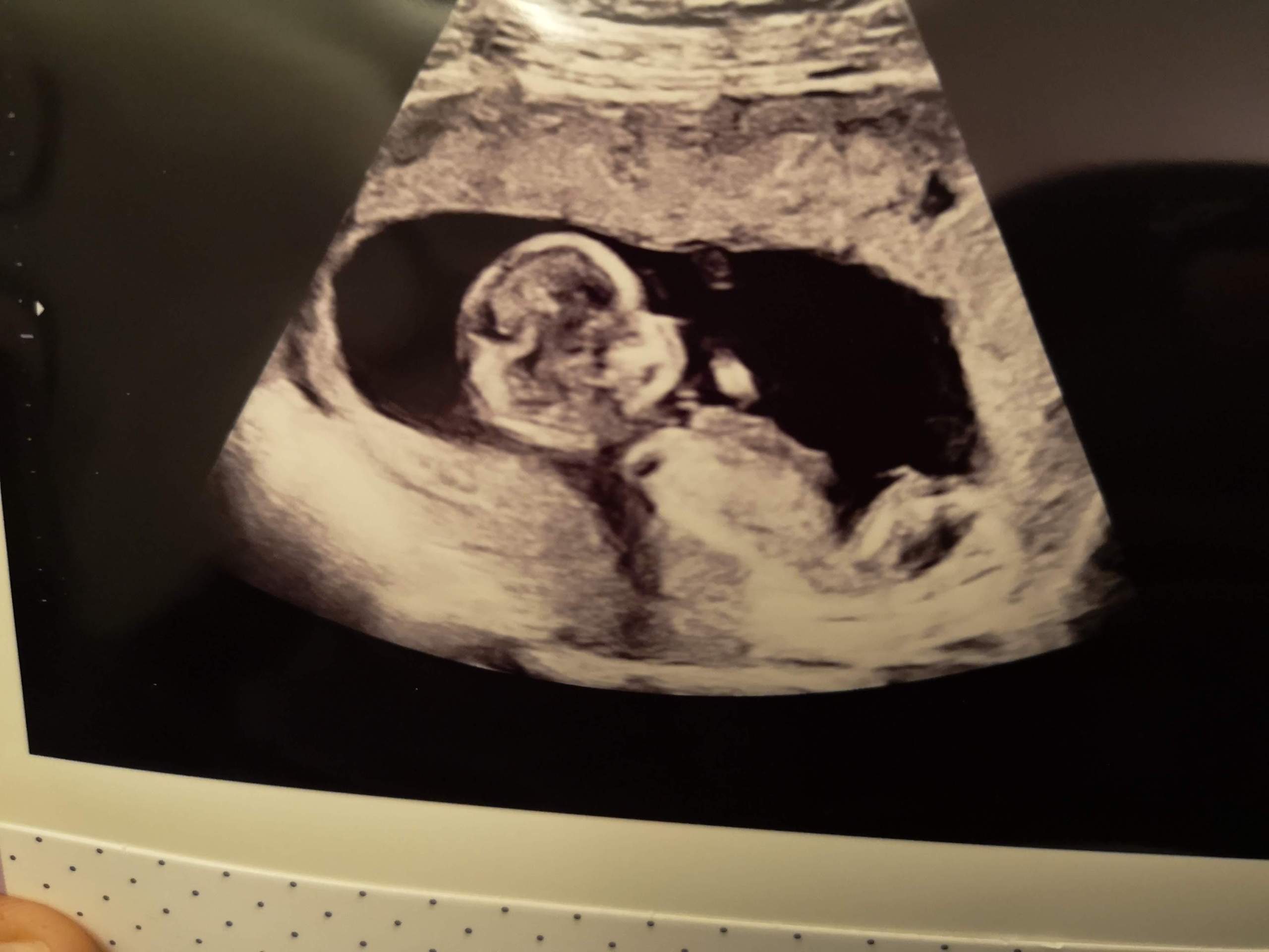 Ein Junge oder Mädchen? (Schwangerschaft, ultraschallbild)