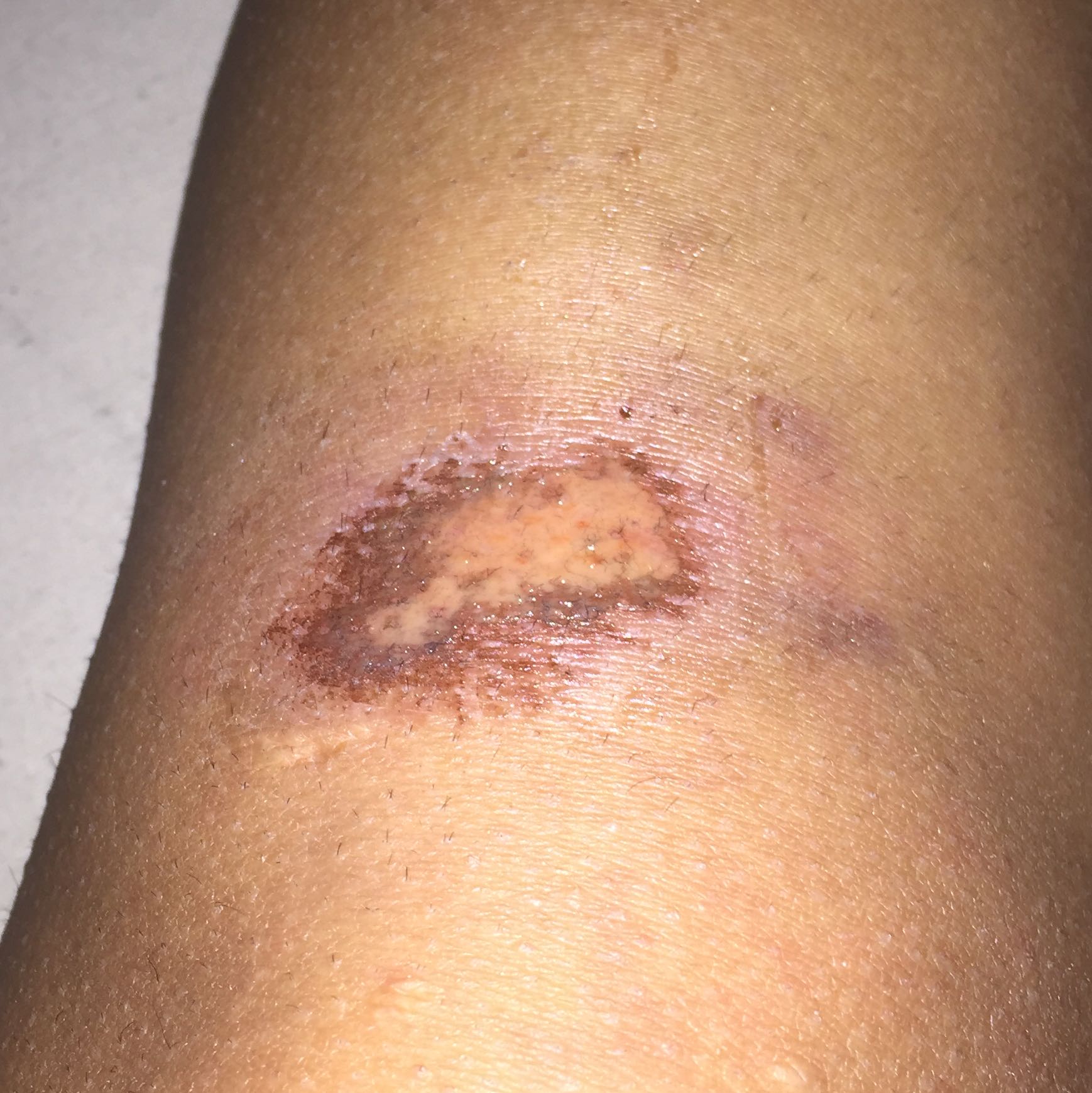 Ein offene wunde aber kein Verband da und Pflaster hält nicht was tun