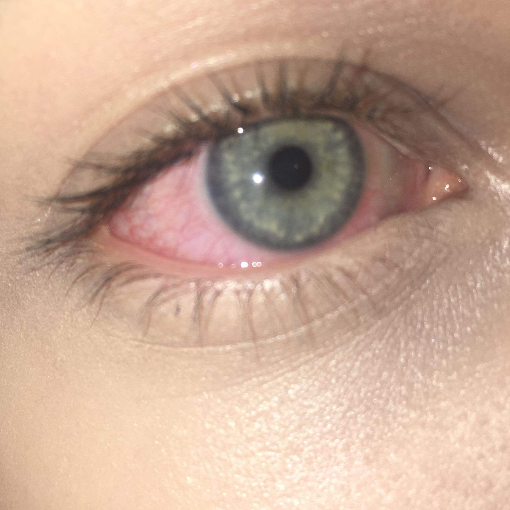 Ein sehr rotes Auge nach kiffen? (Gesundheit und Medizin, Drogen, Augen) Ein sehr rotes Auge nach kiffen? (Gesundheit und Medizin, Drogen, Augen)