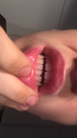 Ein Stuck Vom Vorder Zahn Ist Abgebrochen Was Tun Zahne
