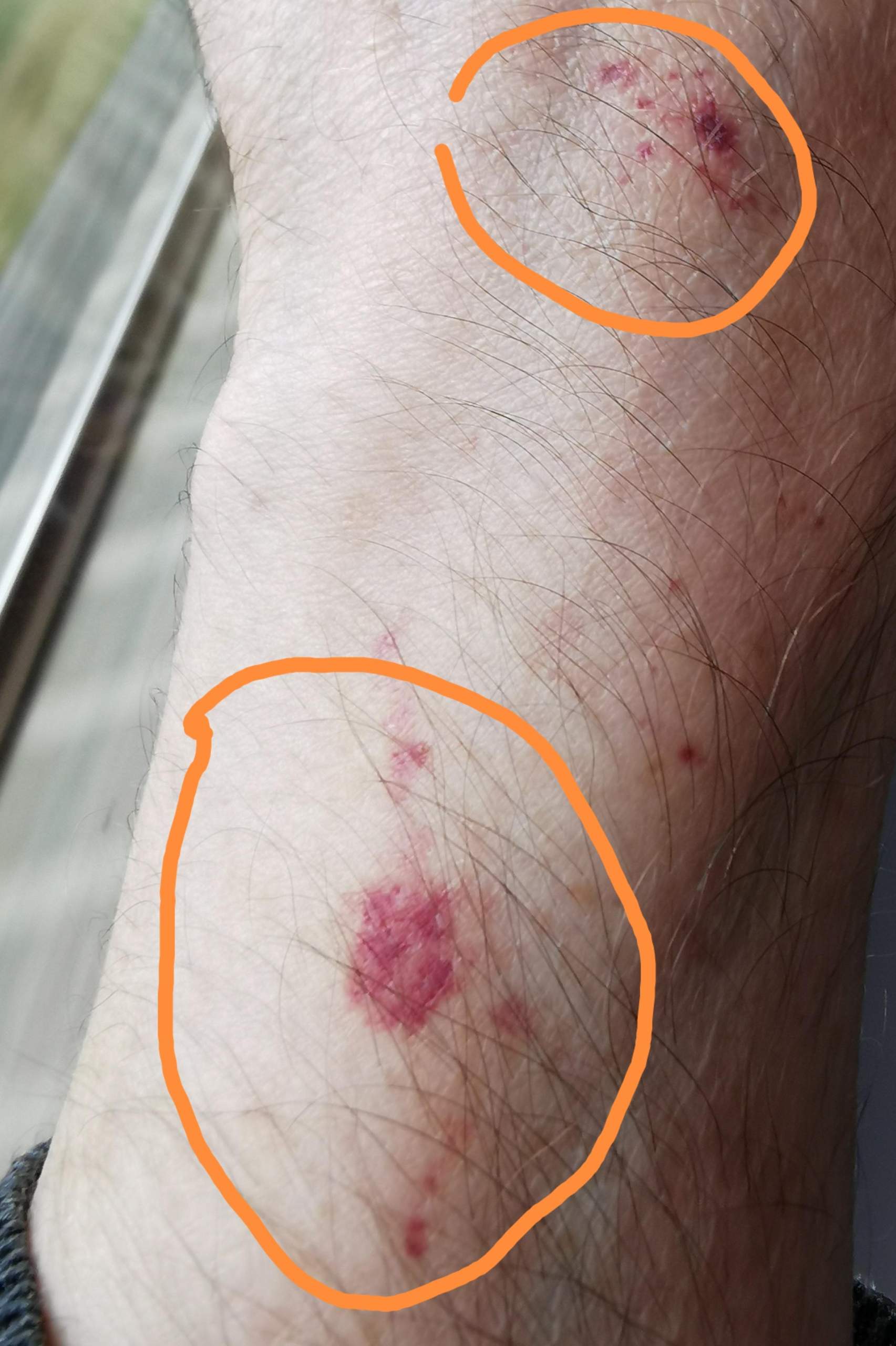 Wie Sehen Einblutungen Auf Der Haut Aus