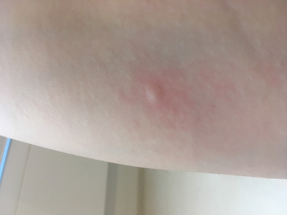 Beule Am Arm Unter Der Haut