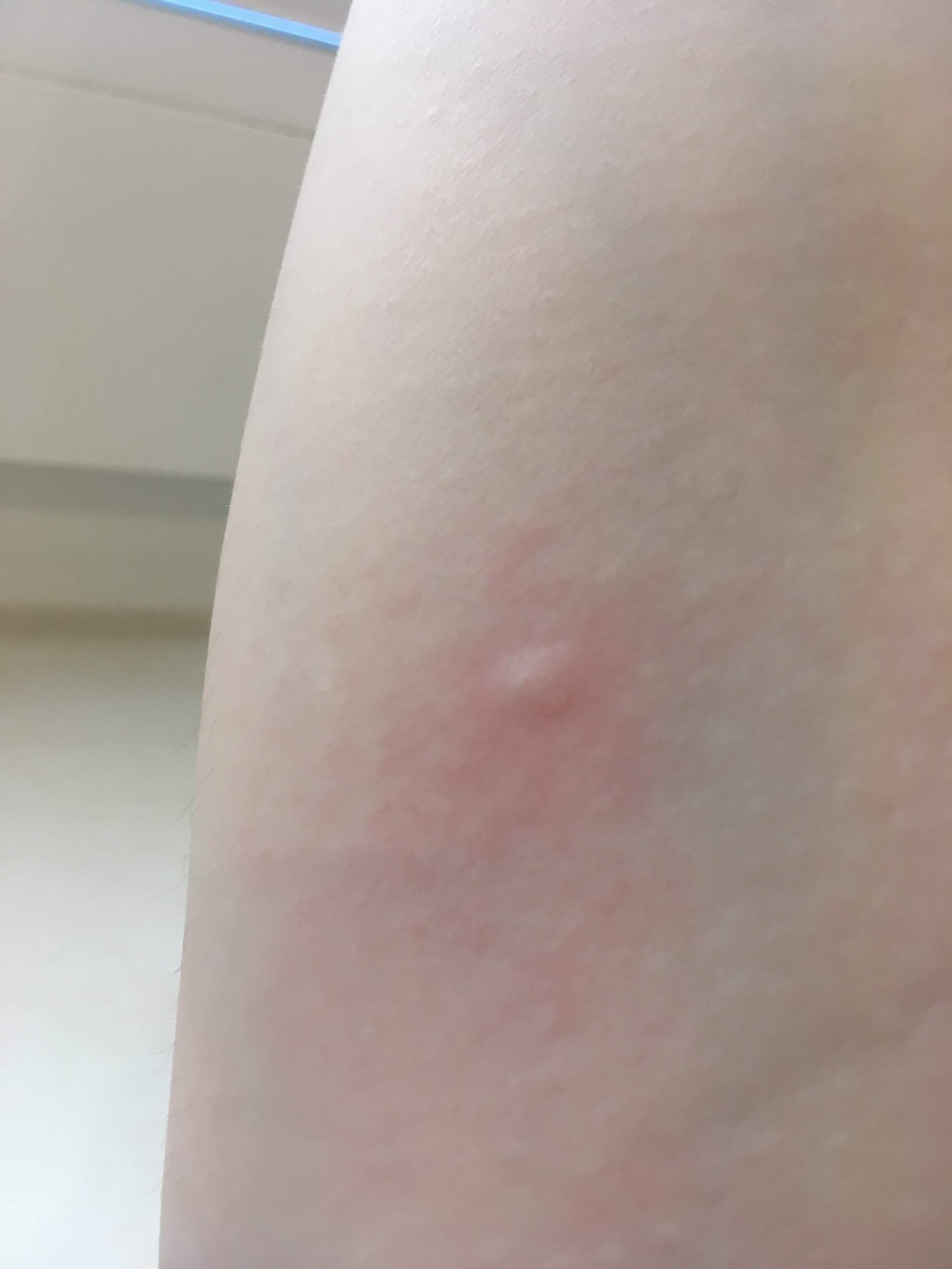 Eine kleine weiße Beule am Arm? (Krankheit, Allergie, Juckreiz)