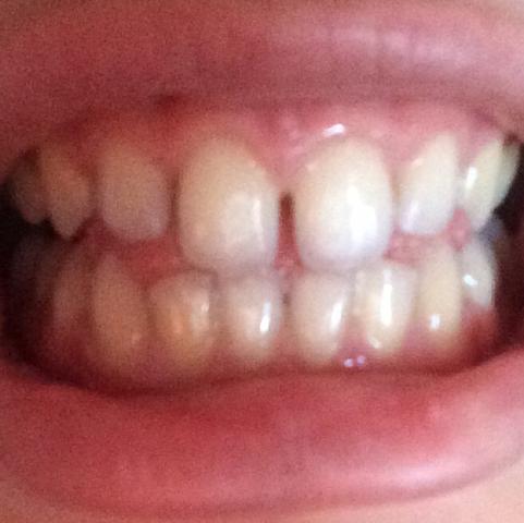 Meine vorderen Schneidezähne 
 - (Zähne, Zahnspange, Feste)