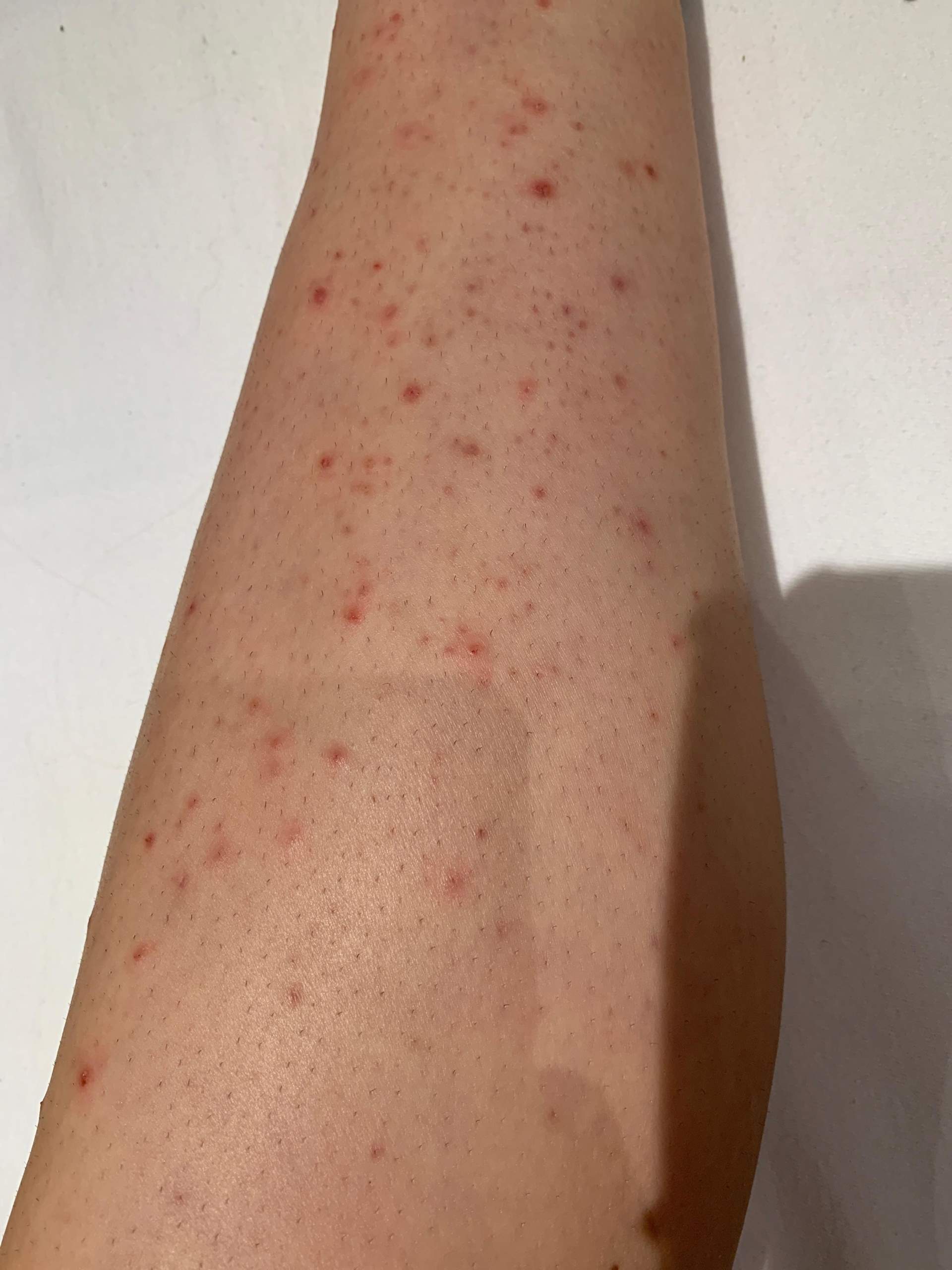 Eingewachsene Haare? (Gesundheit und Medizin, Pickel, Entzündung)