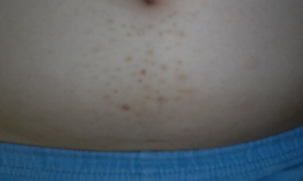 eingewachsene haare am bauch