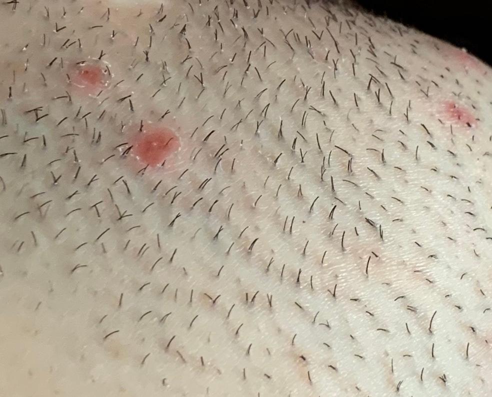 eingewachsene haare intimbereich