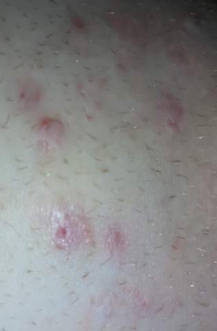 eingewachsene haare was kann ich