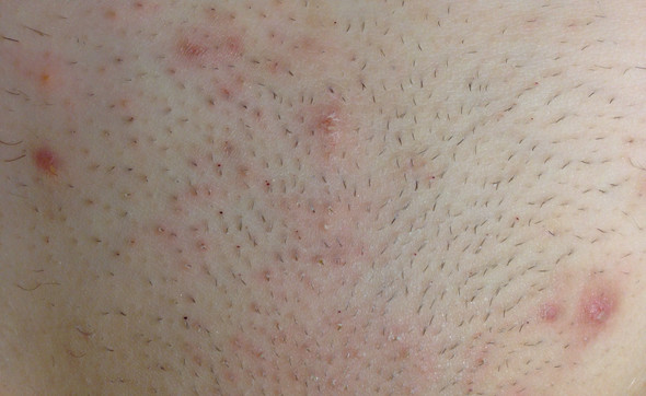 eingewachsene haare verletzungen