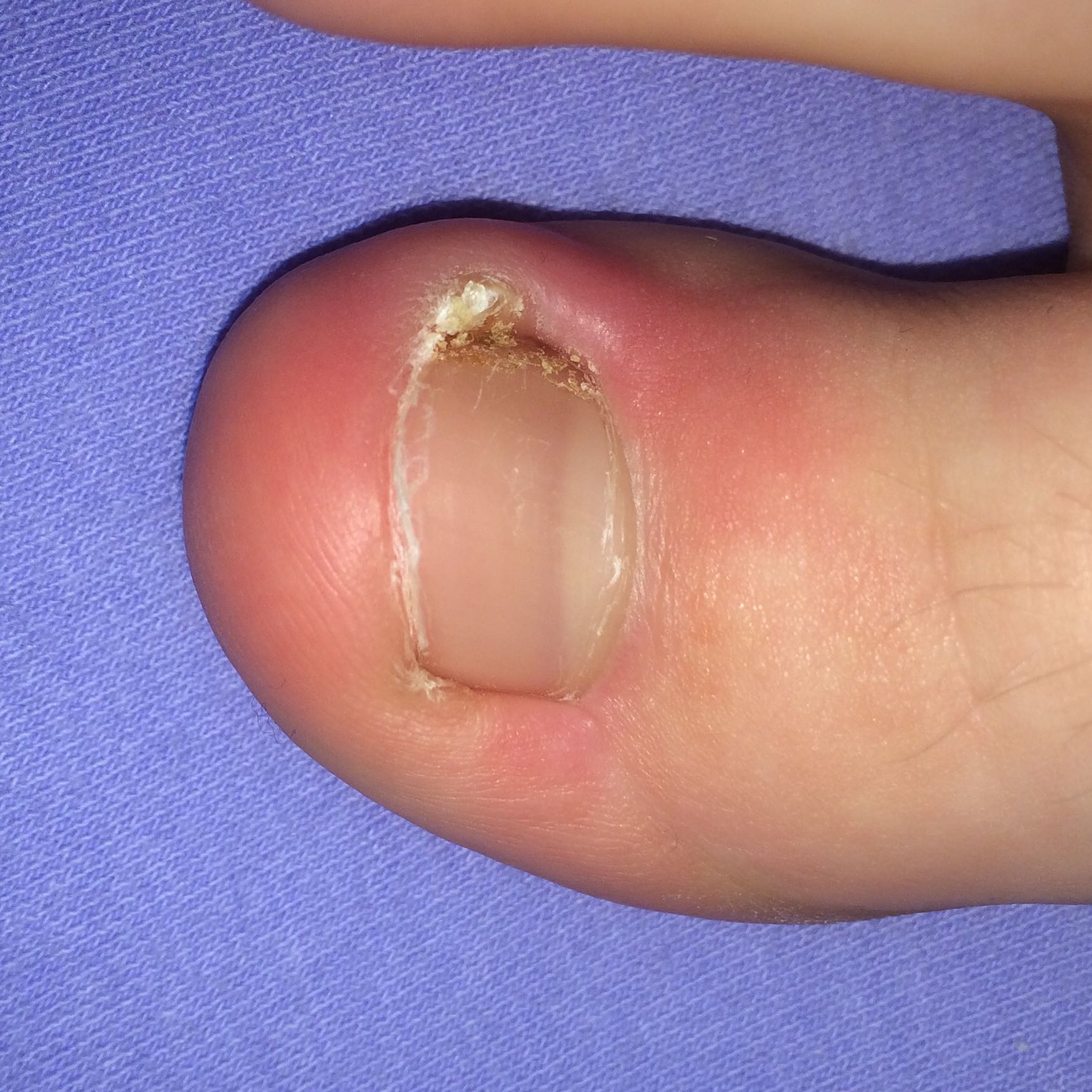 Eingewachsener Nagel Was Soll Ich Tun Gesundheit Umfrage Nagel Eingewachsener Nagel Was Soll Ich Tun Gesundheit Umfrage Nagel