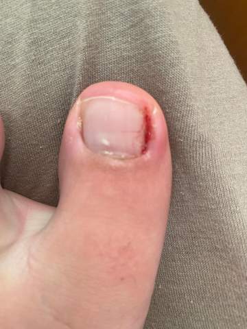 Eingewachsener Zehen Im Urlaub Eingewachsener Zehnagel Zehnagel Eingewachsen Eingewachsener Zehen Im Urlaub Eingewachsener Zehnagel Zehnagel Eingewachsen