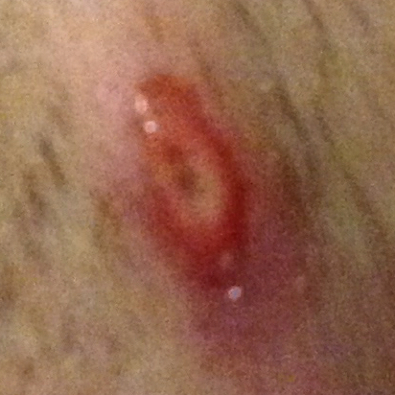 eingewachsenes entzundetes haar haare