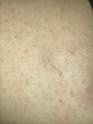 Eingewachsenes Haar Entfernen Am Bein Gesundheit Haare Beauty Eingewachsenes Haar Entfernen Am Bein Gesundheit Haare Beauty