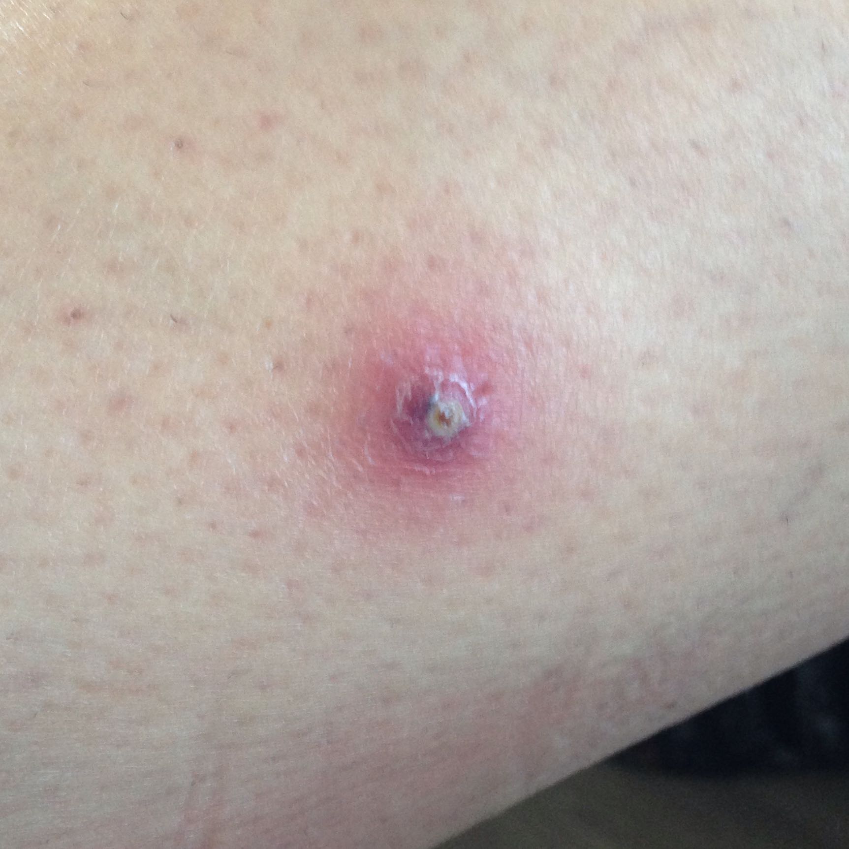 eingewachsenes haar entzundet haut