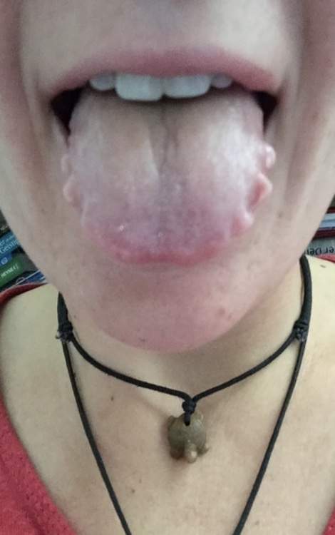 Zungenpiercing entzündung unter der zunge