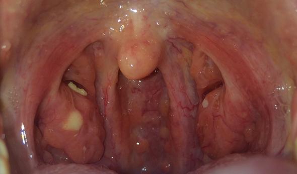 Eiter an den Mandeln (Angst, Schmerzen) Eiter an den Mandeln (Angst, Schmerzen)