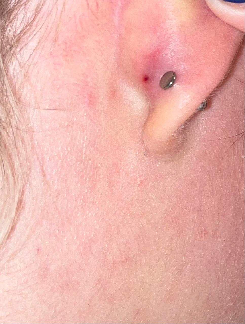 Eiter Ansammlung hinter ohr? (Schmerzen, Piercing, Entzündung)