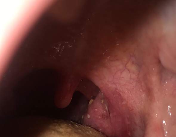 Eiter Auf Den Mandeln Oder Was Ist Es Gesundheit Und Medizin Hno Mandelsteine Eiter Auf Den Mandeln Oder Was Ist Es Gesundheit Und Medizin Hno Mandelsteine