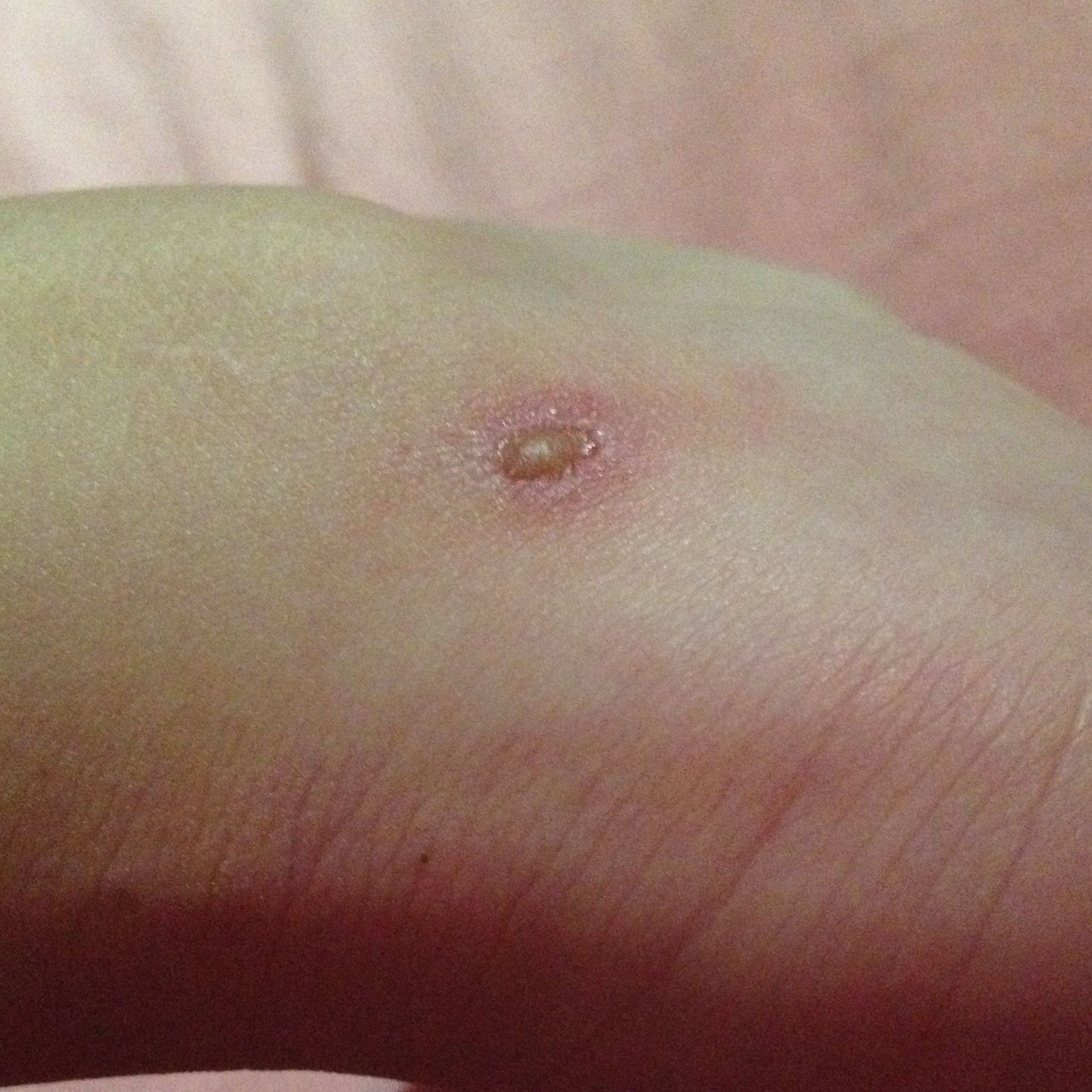 Eiter auf machen oder nicht? (Arzt, Blase)