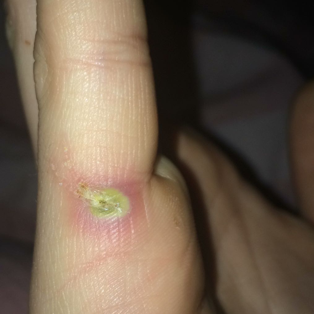 Eiter ausgerückt an der rechten Hand? (Wunde, Kratzer)