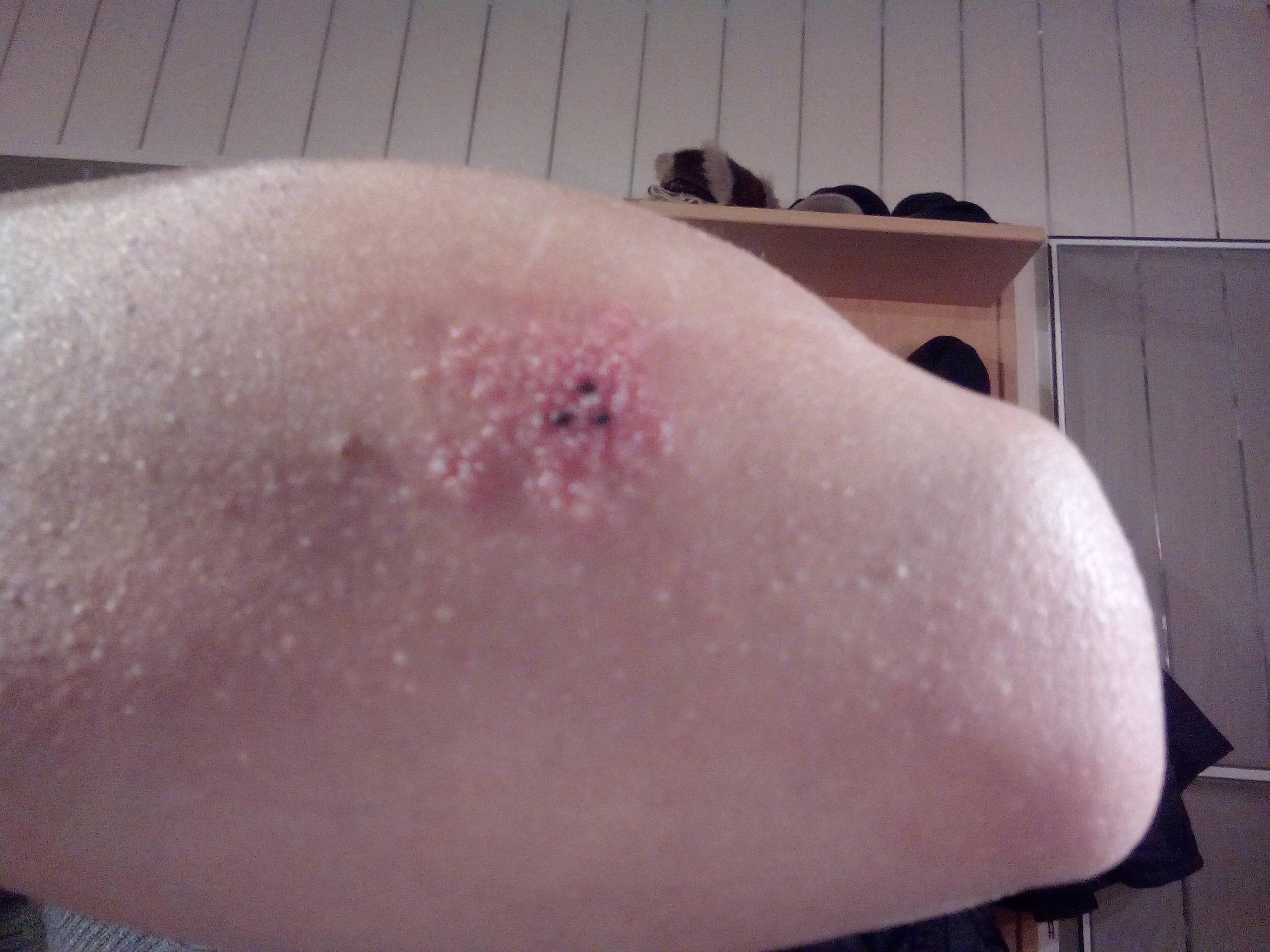 Eiter Bläschen an Tattoo? (Gesundheit und Medizin, entzündet, stick n poke)