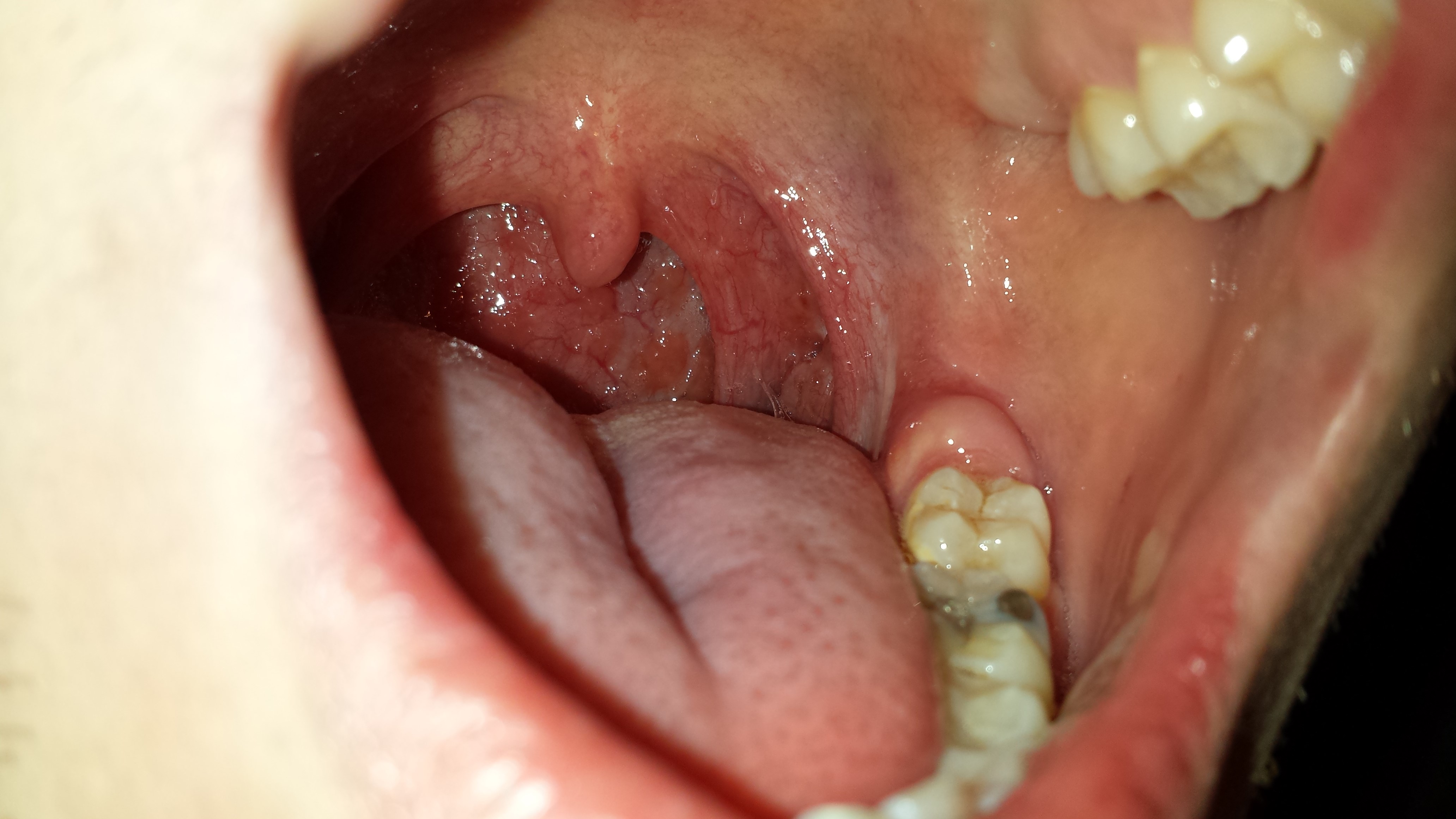 Zahnfleischprobleme, Zahnfleisch blutet, Zahnfleischrückgang