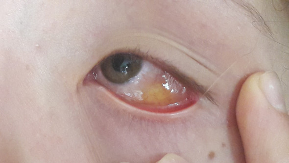 Gelbes Auge - (Augen, Eiter)