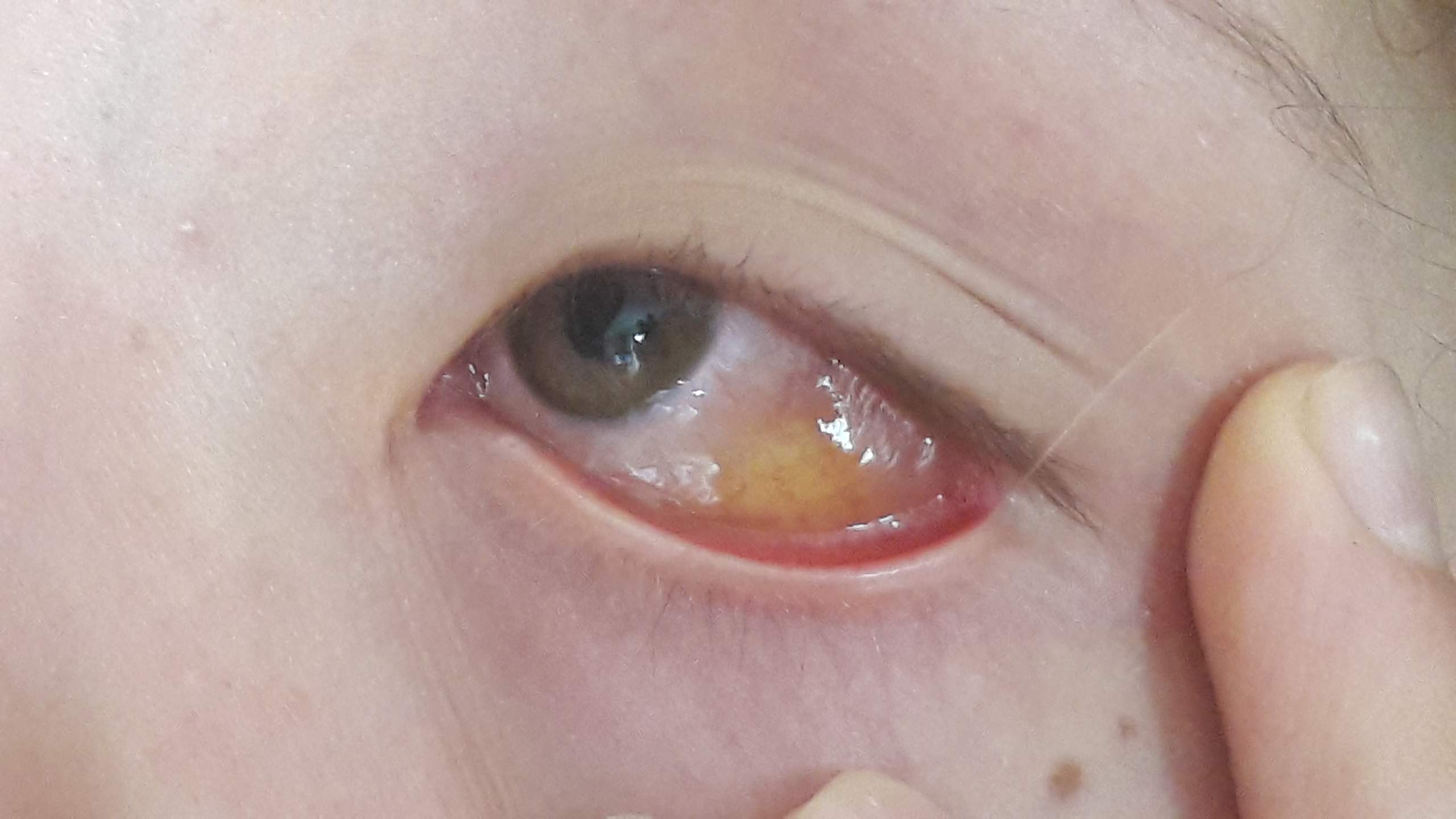 Eiter Im Auge Bindehautentzundung Augen Eiter Im Auge Bindehautentzundung Augen