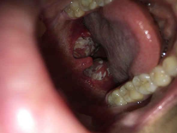 Eiter Oder Mandelsteine Achtung Eklig Gesundheit Und Medizin Mandeln Mandelentzundung Eiter Oder Mandelsteine Achtung Eklig Gesundheit Und Medizin Mandeln Mandelentzundung