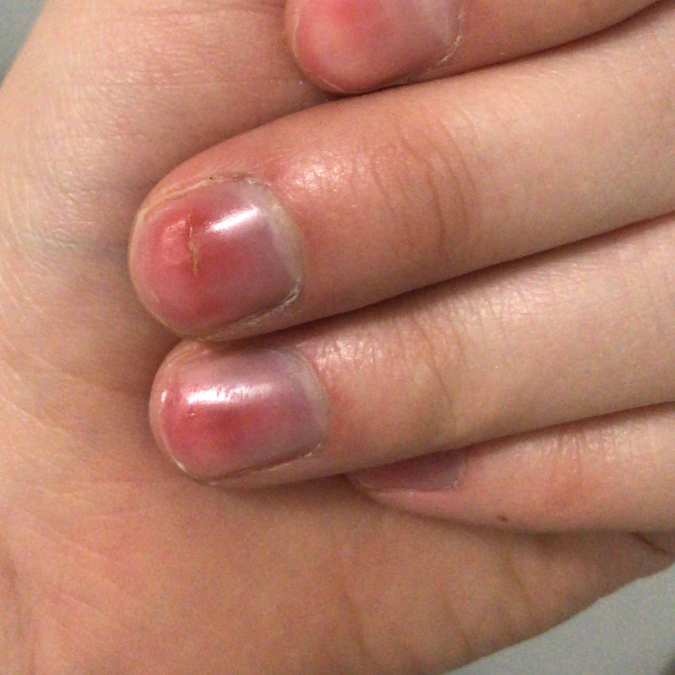 Eiter Und Entzundung Unter Dem Nagel Was Tun Gesundheit Und Medizin Schmerzen Nagel