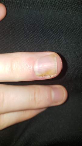 eiter unter dem finger nagel was tun gesundheit und medizin gesundheit nagelbettentzundung