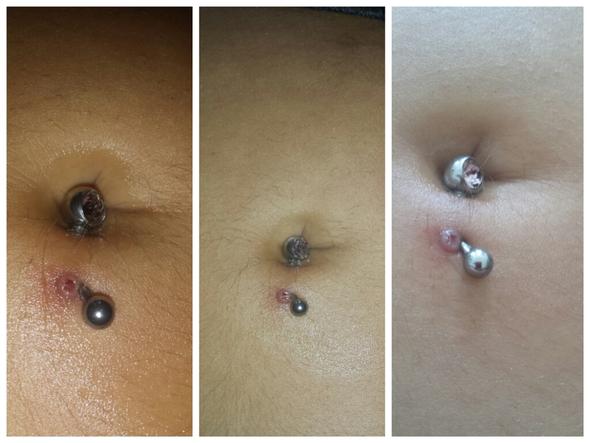 Eiter Blase Bauchnabel Piercing Blut Bauch Entzundung