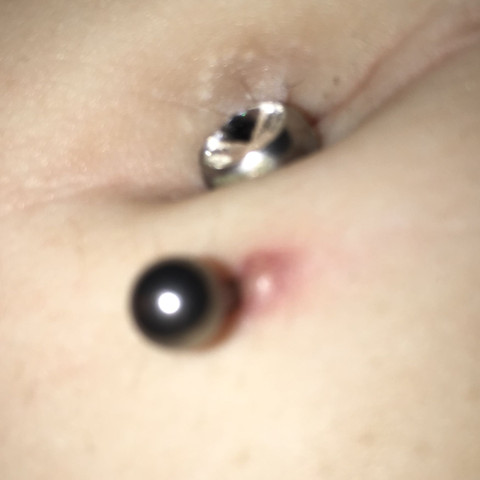 Eiterblase bauchnabelpiercing Eiterblase bauchnabelpiercing