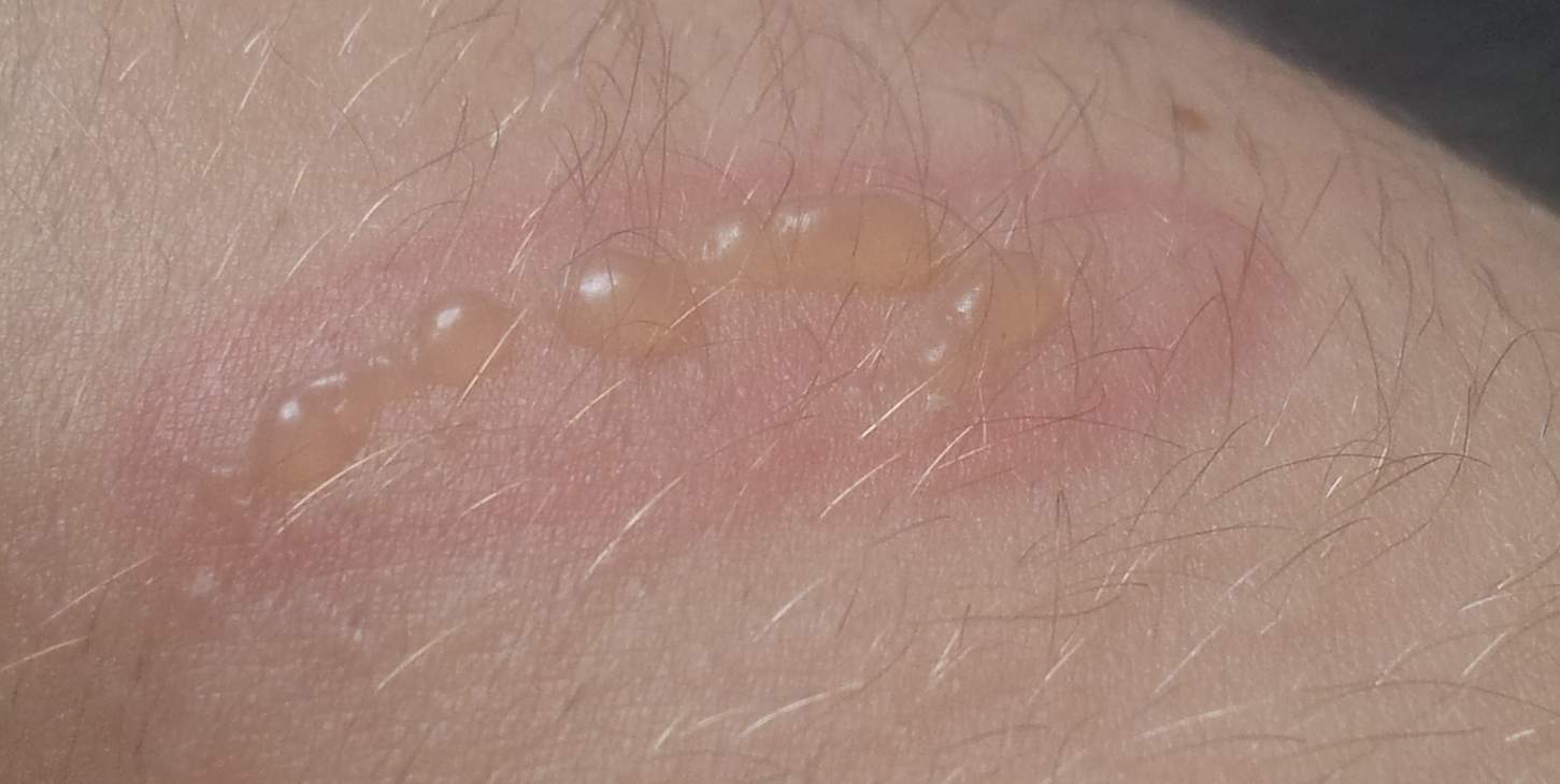 Eiterblasen am Arm die von einem roten ring um geben sind (Wasser