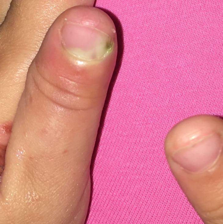 Eiterfinger und Nagel was tun? (Gesundheit und Medizin, Nägel, Eiter)