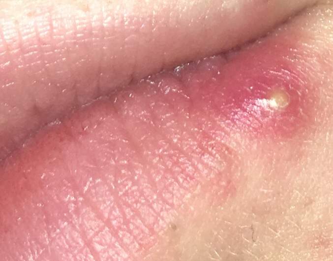 Lippe pickel oberhalb der Geschwollene Lippe