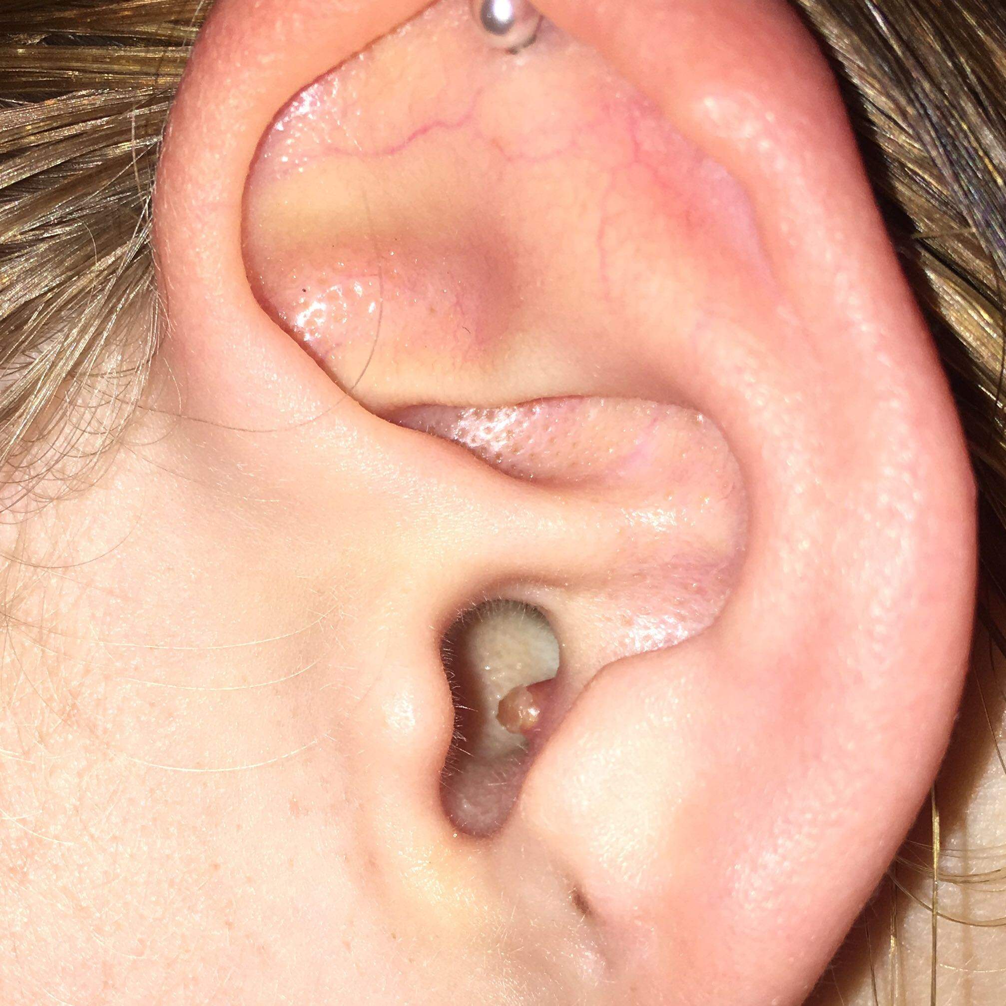 Eiterpickel im Ohr? (Gesundheit und Medizin, Arzt, Schmerzen)