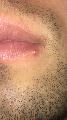 Get Pickel An Der Lippe Oder Herpes Gif