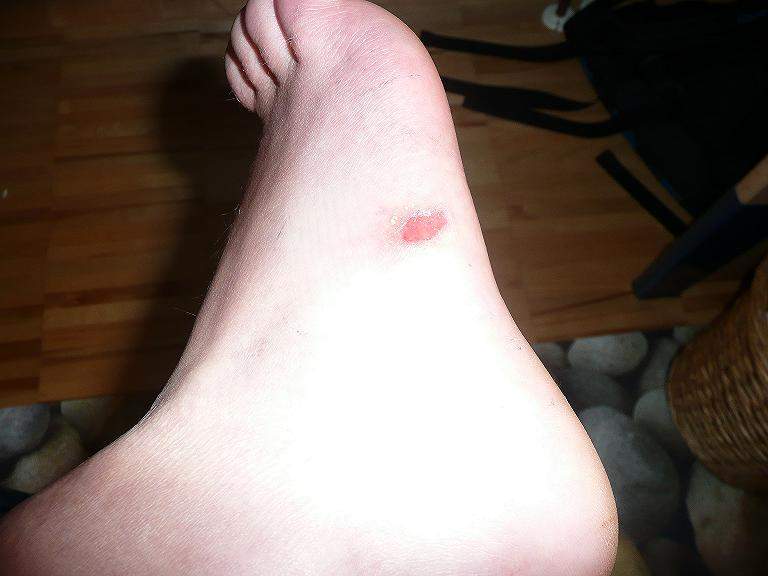 Eitrige Blase am Fuß, was kann ich tun? (Füße, Eiter)