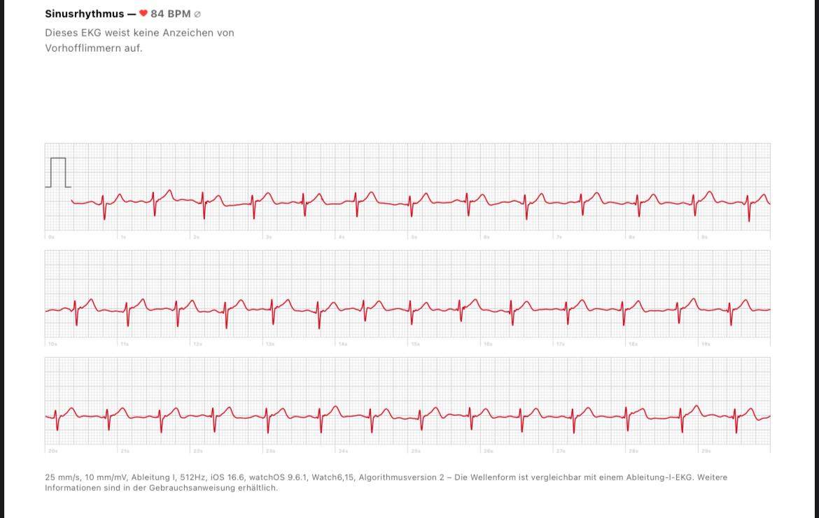apple watch ekg genauigkeit