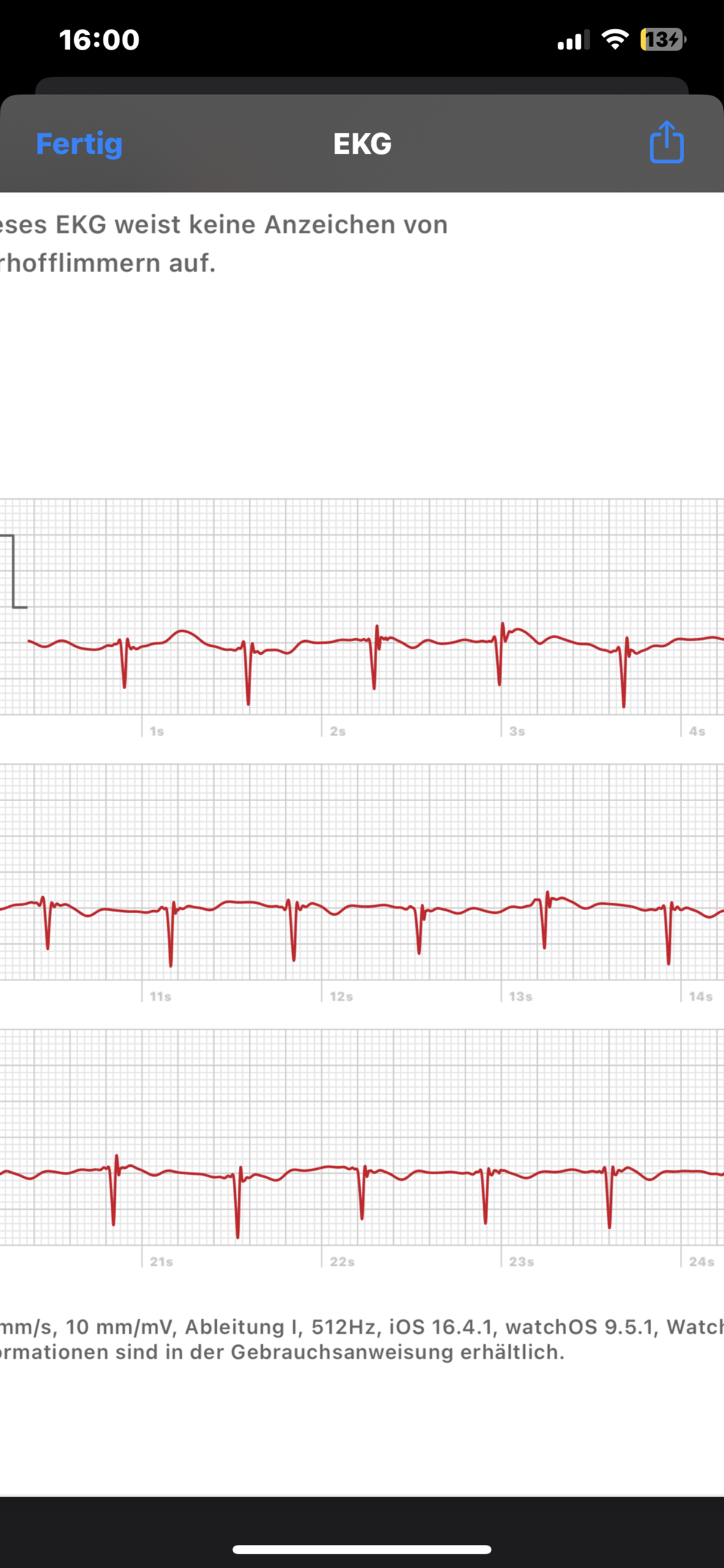EKG Apple Watch am Knochel Kardiologie