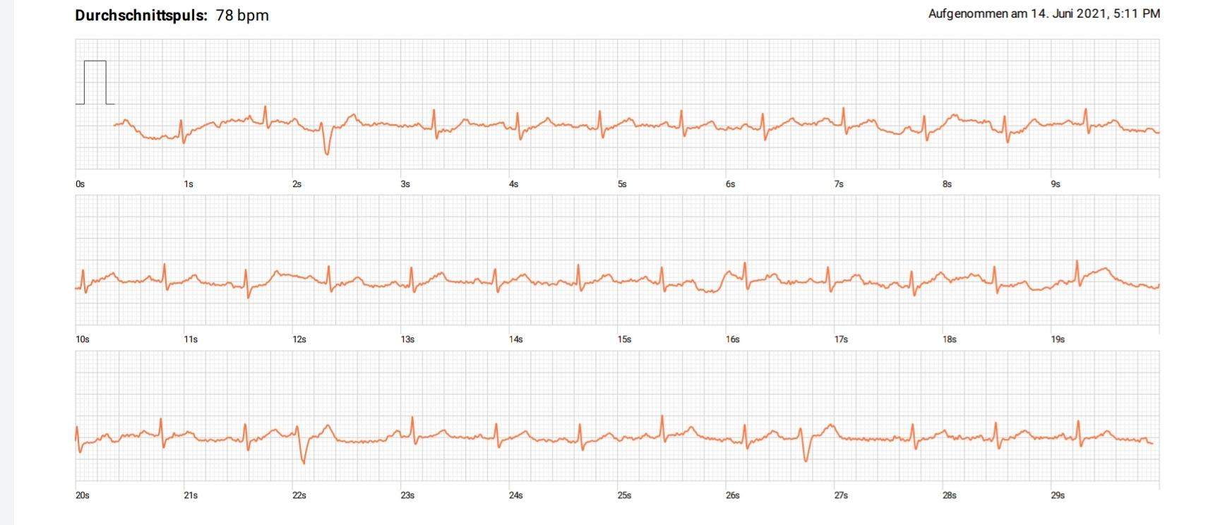 EKG Beurteilung, bitte nur Mediziner oder Fachpersonen? (Gesundheit und Medizin, Medizin, Arzt)