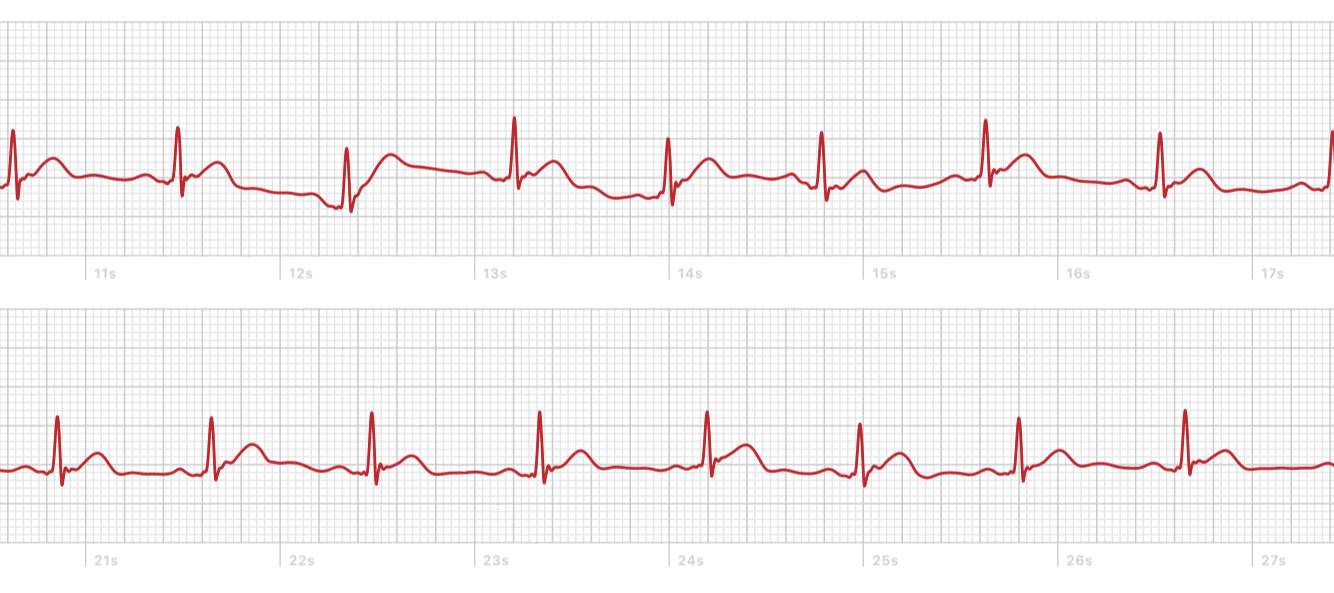 EKG Herzschlag normal? (Gesundheit, Herz, Herzschmerz)