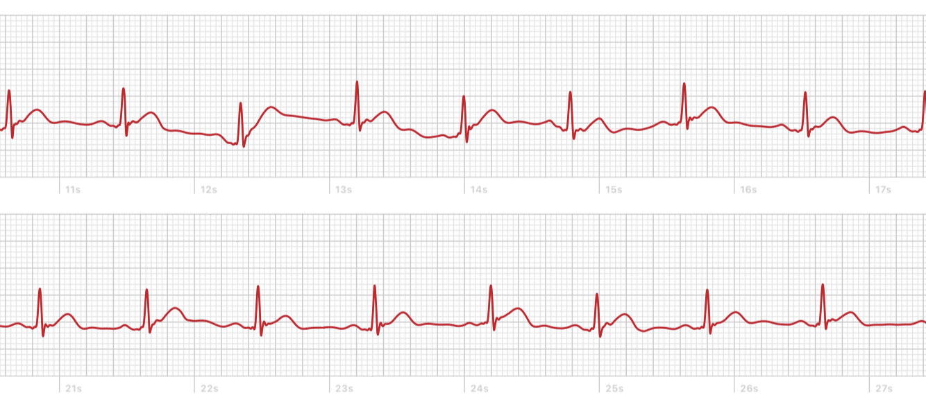EKG Herzschlag normal? (Gesundheit, Herz, Herzschmerz)