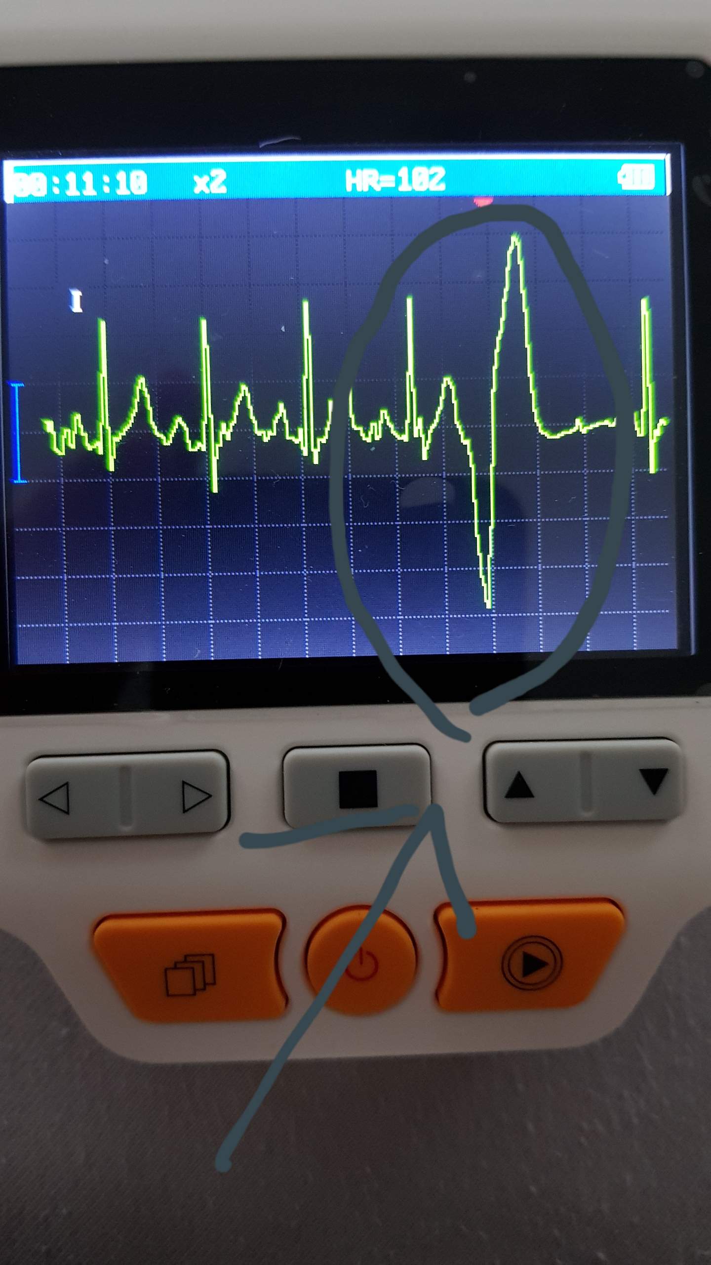 EKG Kurve Beurteilen? (Gesundheit Und Medizin, EKG Befund)